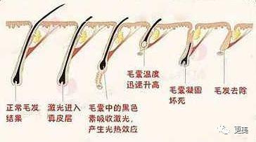 强脉冲脱毛技术与单部位色素沉着的机制解析——以刘亦菲“黑部”舆情为例