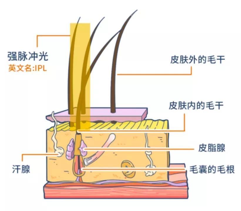 家用脱毛仪真实评测 强脉冲光技术到底靠不靠谱？